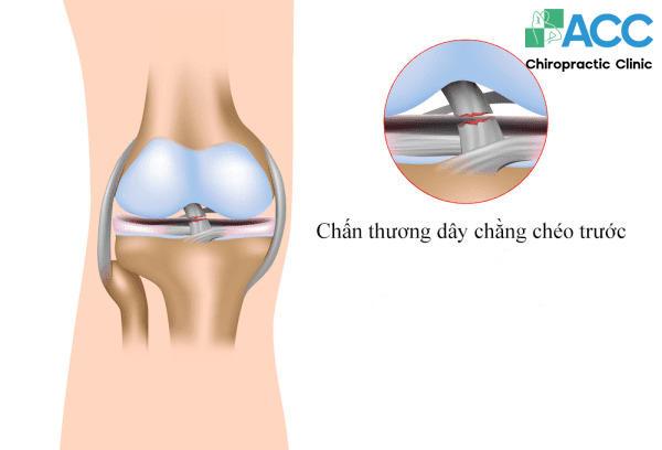 13 loại chấn thương đầu gối thường gặp và cách điều trị