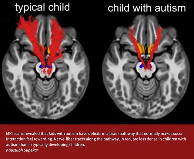 Vì sao bệnh Tự Kỷ (Autism) ngày càng nhiều?