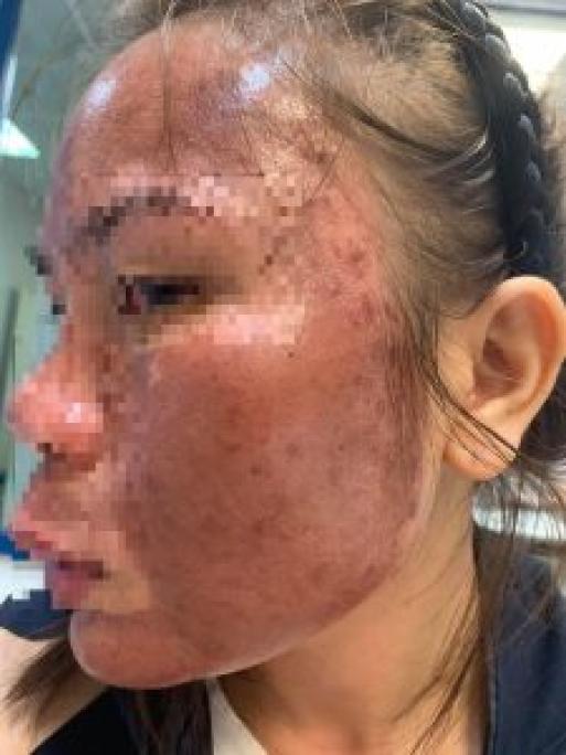 Cô gái trẻ “cháy” mặt vì bôi dưỡng chất trị nám và trứng cá