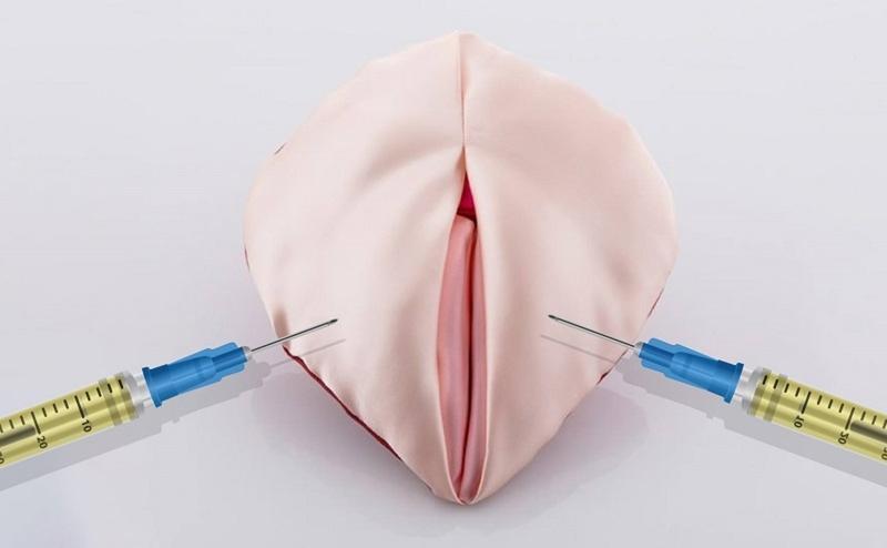 Tổng quan về phương pháp tiêm filler vùng kín dành cho chị em phái đẹp