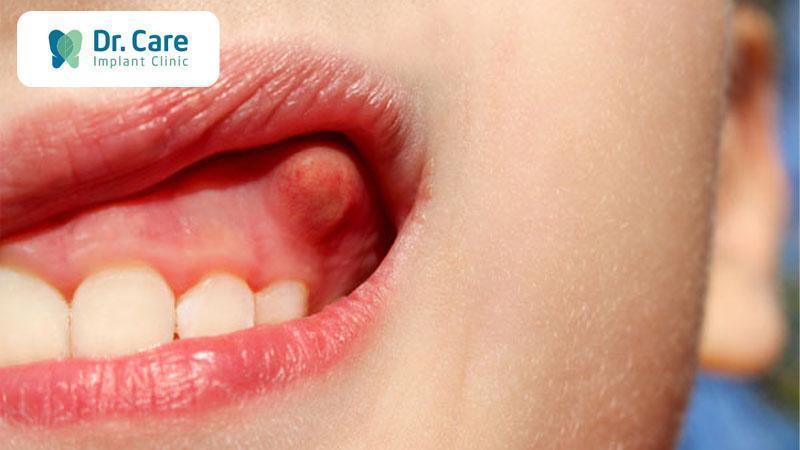 Áp xe răng là gì? Nên là gì khi bị áp xe răng?