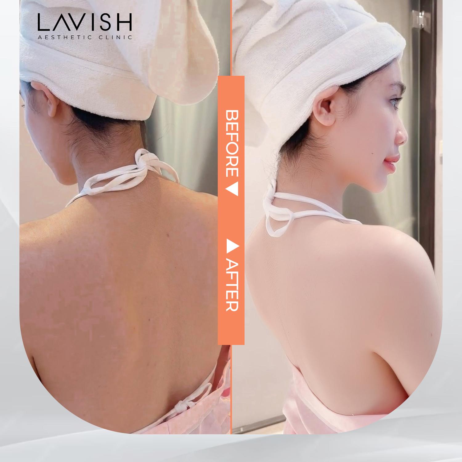 Lưng trần nõn nà, tự tin thả dáng nhờ Phun Nano Oxy trắng da Pura Spa từ Hoa Kỳ