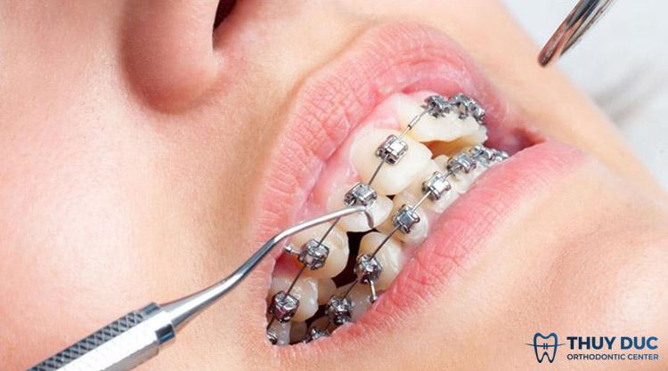 Niềng răng bao lâu siết một lần?