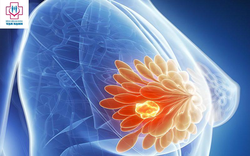 Nổi hạch ở vú, sờ thấy đau có phải dấu hiệu ung thư vú không? - Bệnh viện Đa khoa Vạn Hạnh
