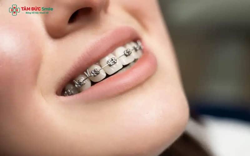 Niềng răng tiếng Anh là gì? Braces, Orthodontics, Invisalign, Retainer