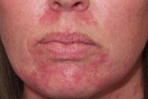 Viêm da quanh miệng: Triệu chứng, nguyên nhân và cách điều trị