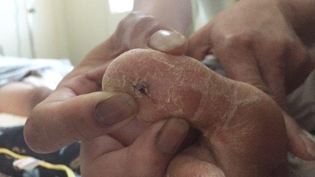 Giẫm vào gai bưởi, bé trai 15 tuổi mắc uốn ván nặng