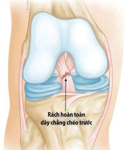 Chấn thương gối – các tổn thương thường gặp và hướng điều trị