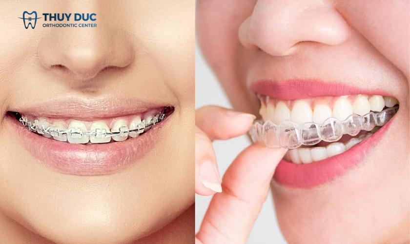 Nên niềng răng trong suốt hay mắc cài?