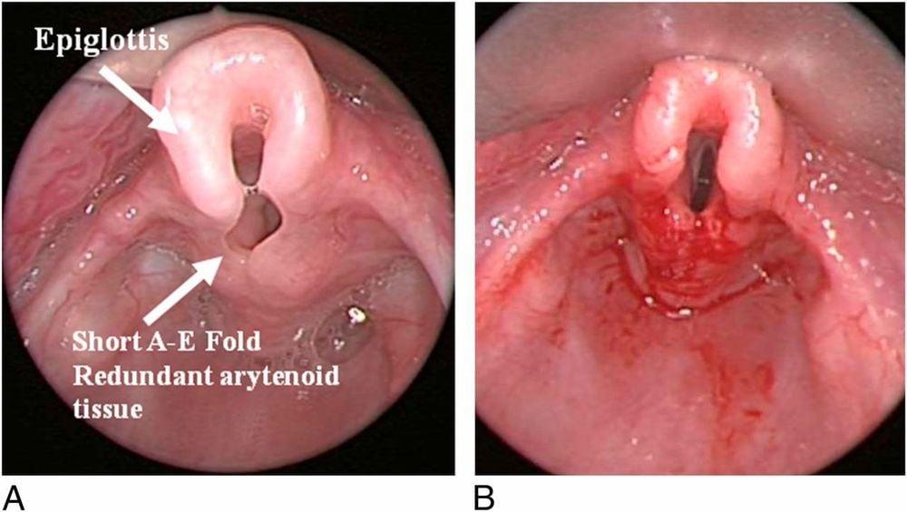 Tổng quan về bệnh viêm thanh thiệt cấp (Acute Epiglottitis)