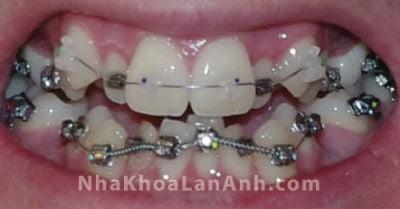Chỉnh nha cho trường hợp răng mọc chen chúc