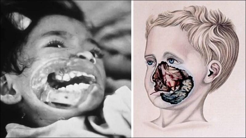 Cam tẩu mã là bệnh gì? Căn bệnh quái ác ăn mòn khuôn mặt